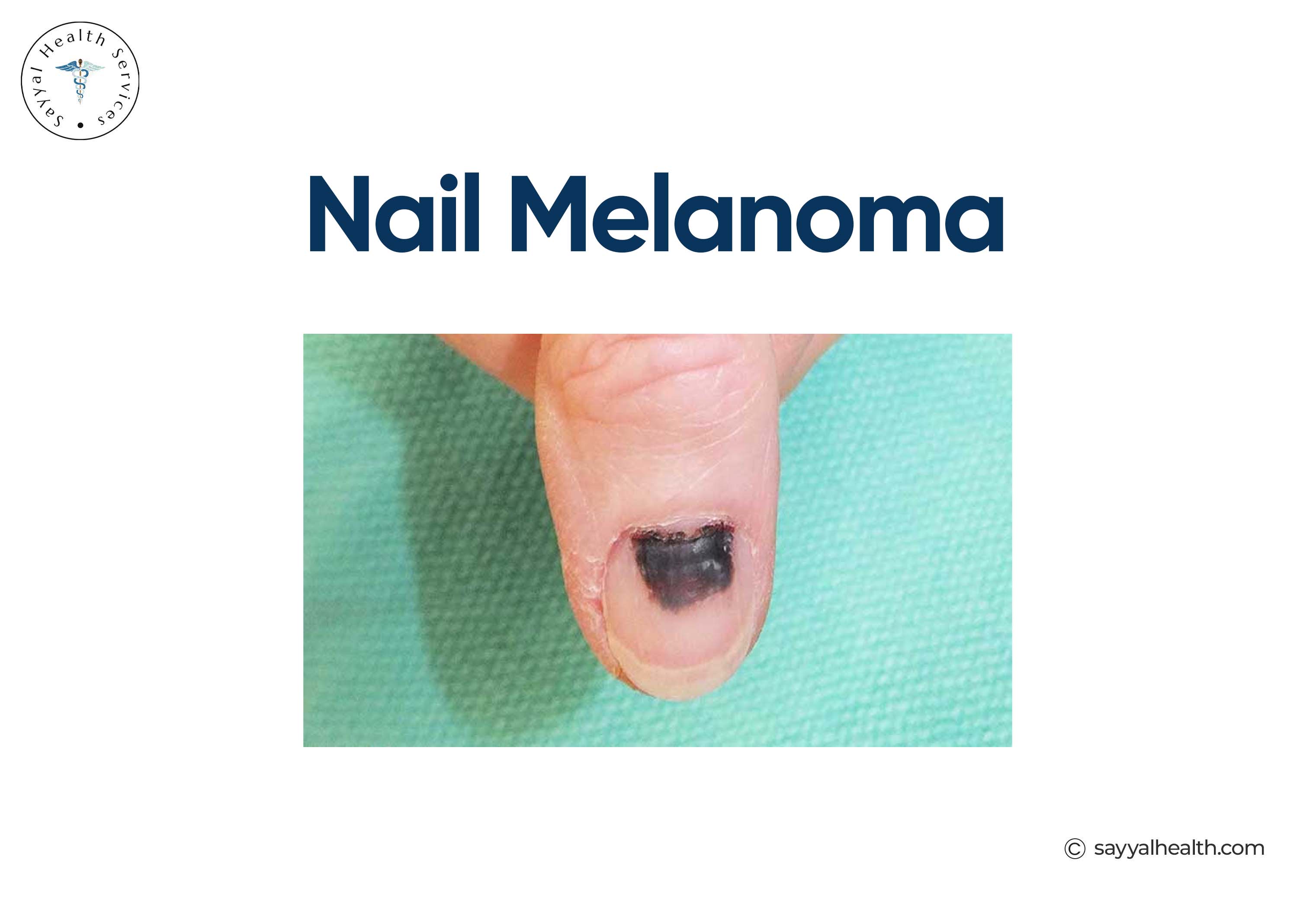 Nail Melanoma in fingernail